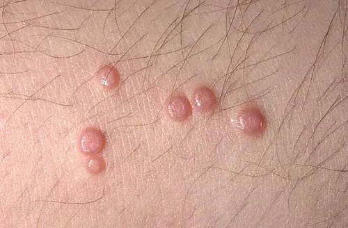 Outra Imagem de Molusco Contagioso