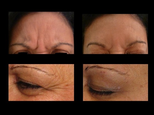 Botox
