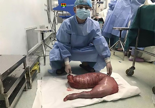 HD Intestino enchido removido.jpg