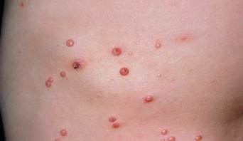 Imagem de Molusco Contagioso